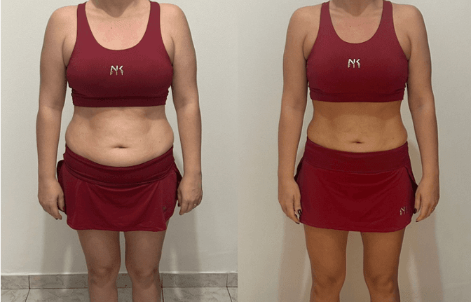 Antes e depois de paciente mulher, vista frontal