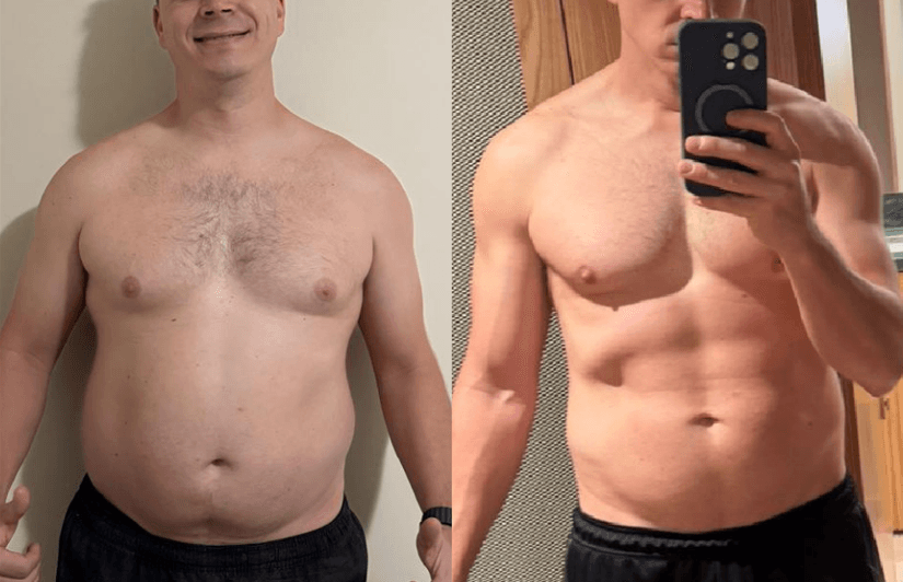Antes e depois de paciente homem, vista frontal